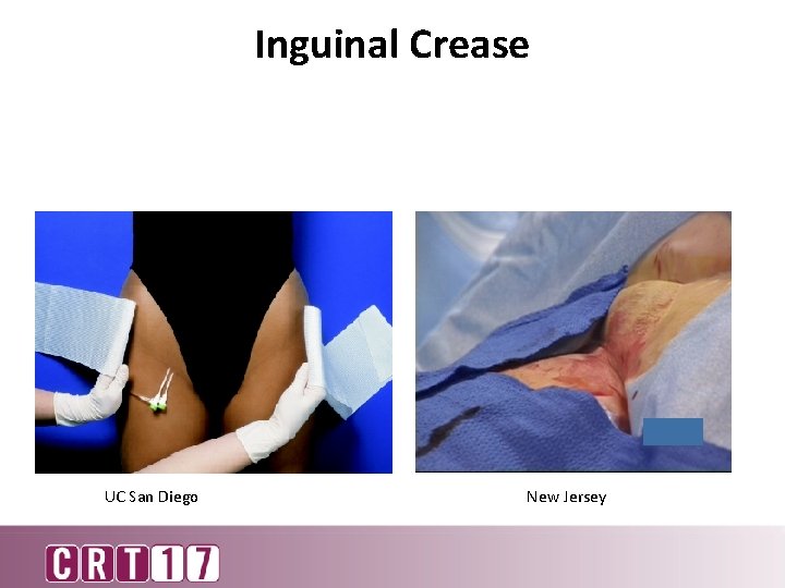 Inguinal Crease UC San Diego New Jersey 