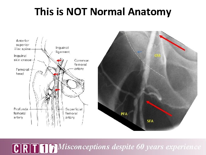 This is NOT Normal Anatomy CFA PFA SFA 3 Misconceptions despite 60 years experience