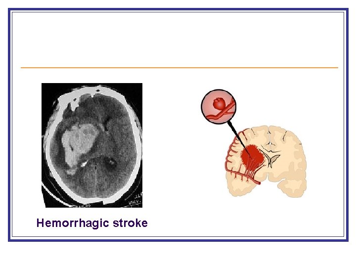 Hemorrhagic stroke 