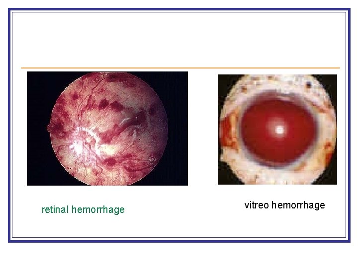 retinal hemorrhage vitreo hemorrhage 