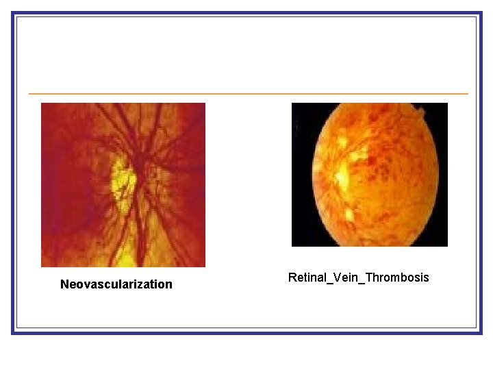 Neovascularization Retinal_Vein_Thrombosis 