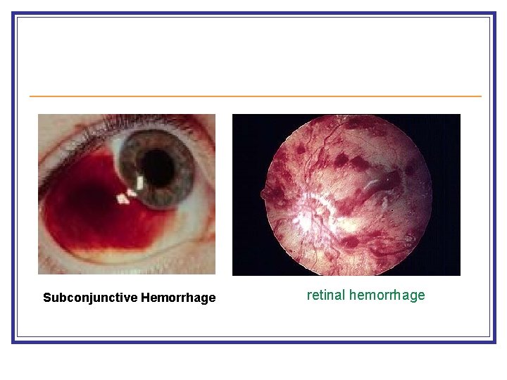 Subconjunctive Hemorrhage retinal hemorrhage 