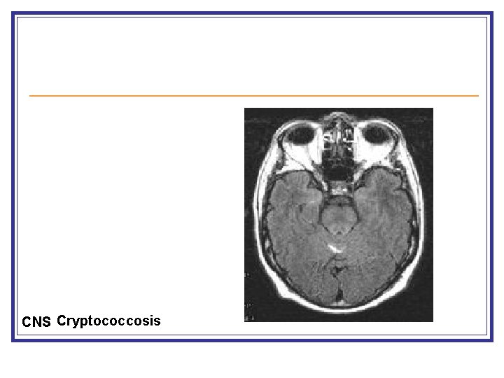 CNS Cryptococcosis 