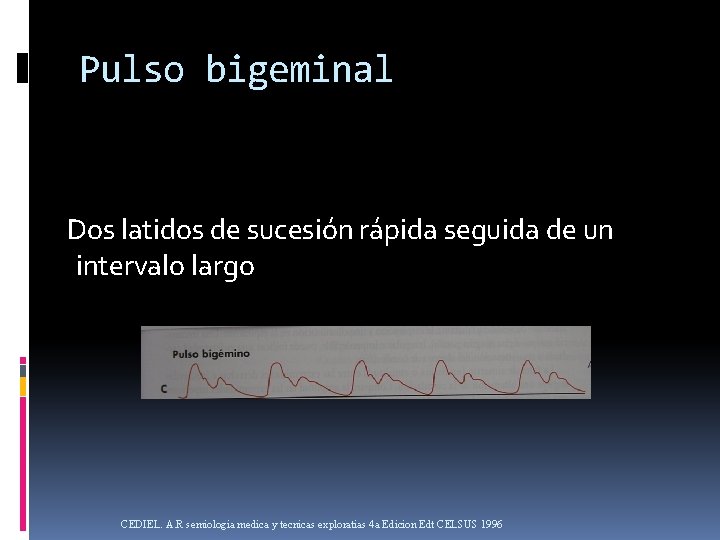 Pulso bigeminal Dos latidos de sucesión rápida seguida de un intervalo largo CEDIEL. A.