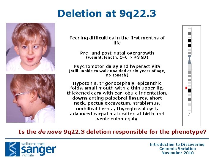 Deletion at 9 q 22. 3 Feeding difficulties in the first months of life Deletion at 9 q 22. 3 Feeding difficulties in the first months of life