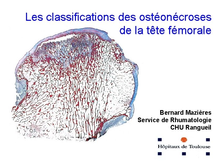 Les classifications des ostéonécroses de la tête fémorale Bernard Mazières Service de Rhumatologie CHU