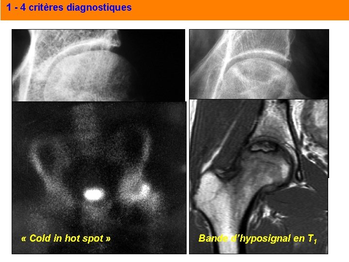 1 - 4 critères diagnostiques décrochage « Cold in hot spot » Liseré de