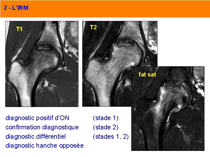 2 - L’IRM T 1 T 2 fat sat diagnostic positif d’ON confirmation diagnostique