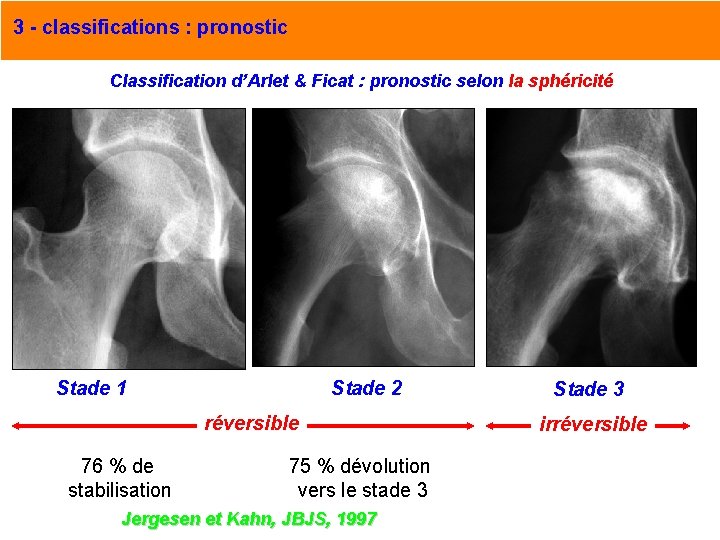 3 - classifications : pronostic Classification d’Arlet & Ficat : pronostic selon la sphéricité