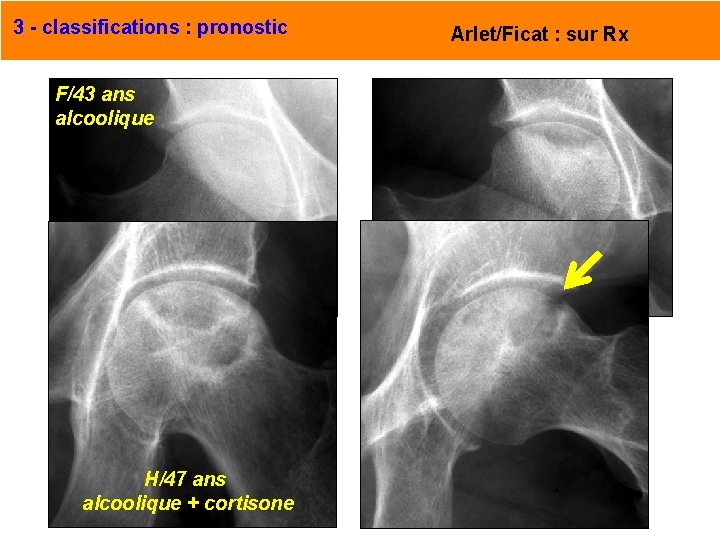 3 - classifications : pronostic Arlet/Ficat : sur Rx F/43 ans alcoolique Face, extension