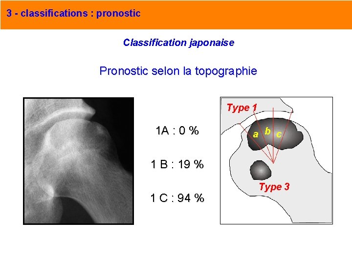 3 - classifications : pronostic Classification japonaise Pronostic selon la topographie Type 1 1