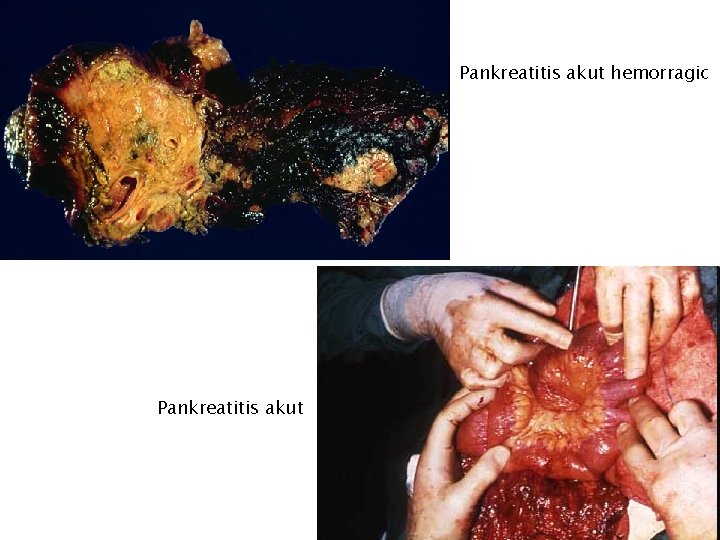 Pankreatitis akut hemorragic Pankreatitis akut 