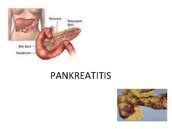 PANKREATITIS 