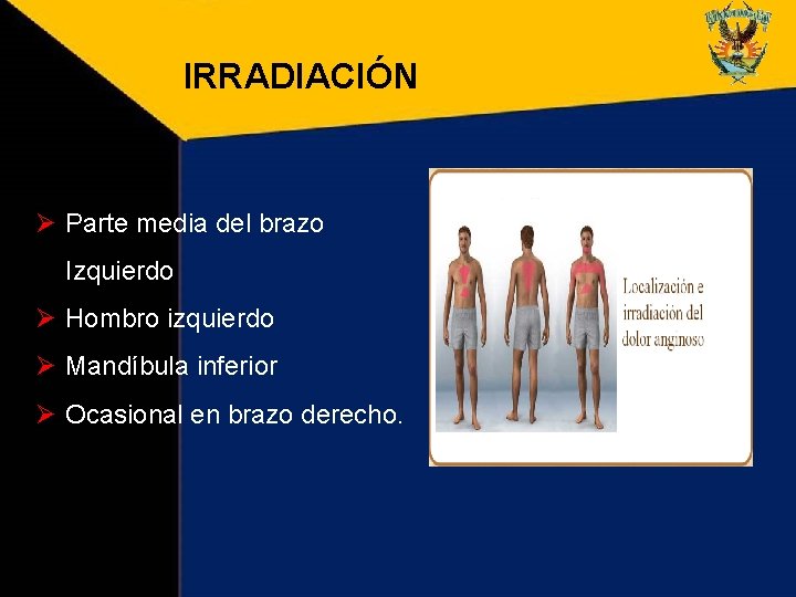 IRRADIACIÓN Ø Parte media del brazo Izquierdo Ø Hombro izquierdo Ø Mandíbula inferior Ø IRRADIACIÓN Ø Parte media del brazo Izquierdo Ø Hombro izquierdo Ø Mandíbula inferior Ø