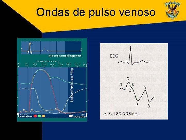 Ondas de pulso venoso Ondas de pulso venoso
