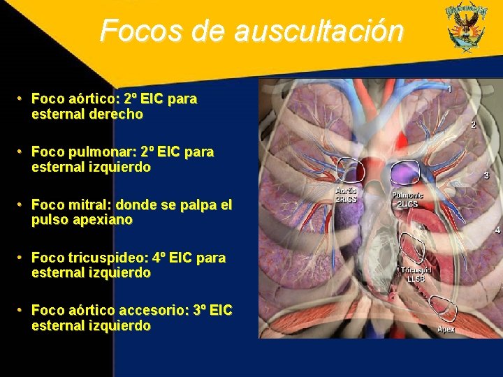Focos de auscultación • Foco aórtico: 2º EIC para esternal derecho • Foco pulmonar: Focos de auscultación • Foco aórtico: 2º EIC para esternal derecho • Foco pulmonar: