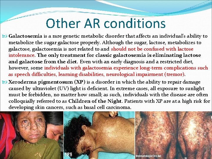 Other AR conditions Galactosemia is a rare genetic metabolic disorder that affects an individual's Other AR conditions Galactosemia is a rare genetic metabolic disorder that affects an individual's