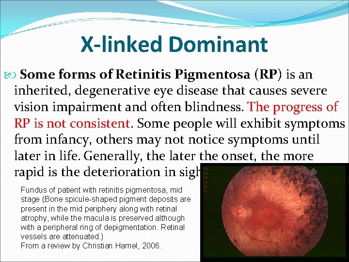 X-linked Dominant Some forms of Retinitis Pigmentosa (RP) is an inherited, degenerative eye disease X-linked Dominant Some forms of Retinitis Pigmentosa (RP) is an inherited, degenerative eye disease