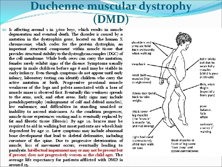 Duchenne muscular dystrophy (DMD) Is affecting around 1 in 3, 600 boys, which results Duchenne muscular dystrophy (DMD) Is affecting around 1 in 3, 600 boys, which results