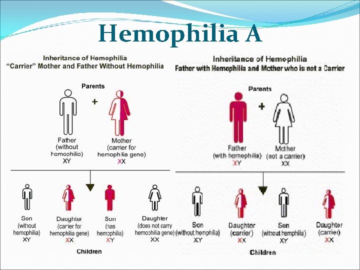 Hemophilia A Hemophilia A