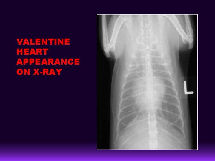 VALENTINE HEART APPEARANCE ON X-RAY 