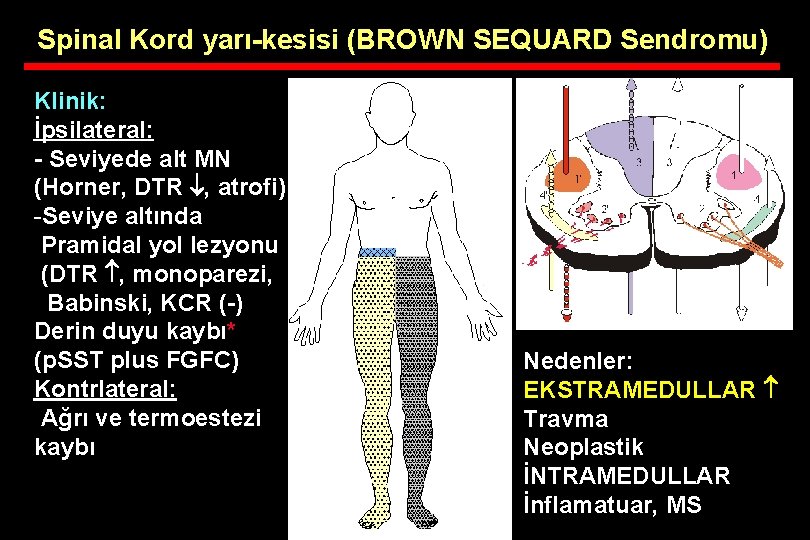 Spinal Kord yarı-kesisi (BROWN SEQUARD Sendromu) Klinik: İpsilateral: - Seviyede alt MN (Horner, DTR