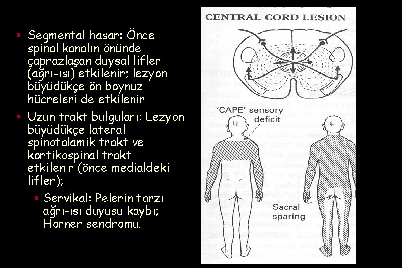 § Segmental hasar: Önce spinal kanalın önünde çaprazlaşan duysal lifler (ağrı-ısı) etkilenir; lezyon büyüdükçe