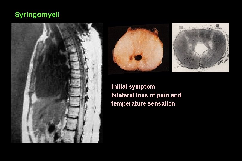 Syringomyeli initial symptom bilateral loss of pain and temperature sensation 