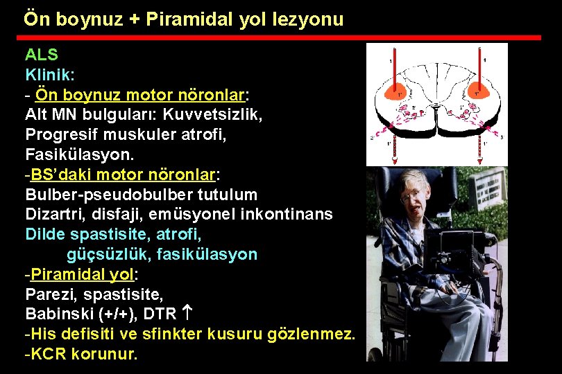 Ön boynuz + Piramidal yol lezyonu ALS Klinik: - Ön boynuz motor nöronlar: Alt