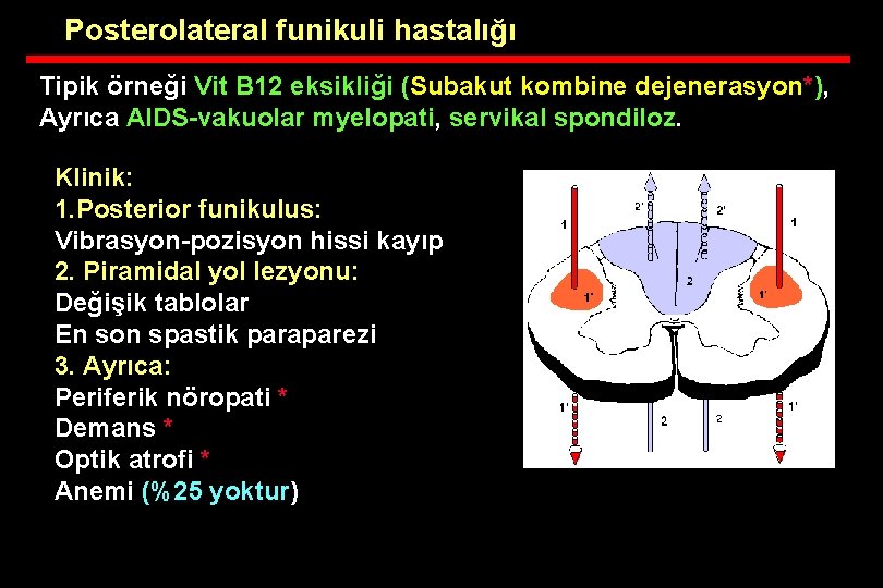 Posterolateral funikuli hastalığı Tipik örneği Vit B 12 eksikliği (Subakut kombine dejenerasyon*), Ayrıca AIDS-vakuolar