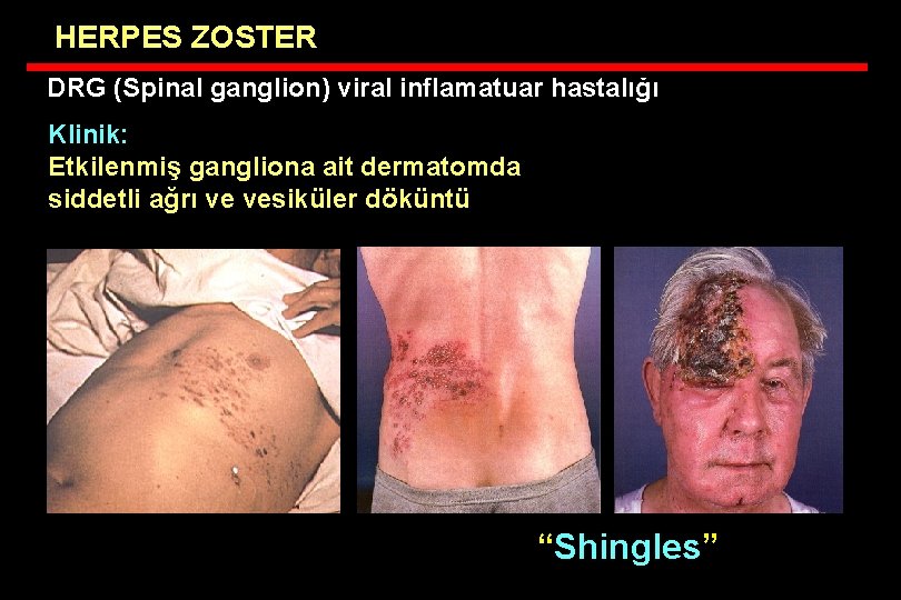HERPES ZOSTER DRG (Spinal ganglion) viral inflamatuar hastalığı Klinik: Etkilenmiş gangliona ait dermatomda siddetli