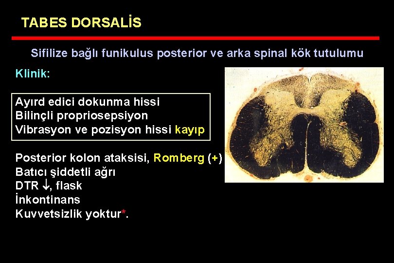 TABES DORSALİS Sifilize bağlı funikulus posterior ve arka spinal kök tutulumu Klinik: Ayırd edici