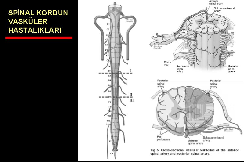 SPİNAL KORDUN VASKÜLER HASTALIKLARI 