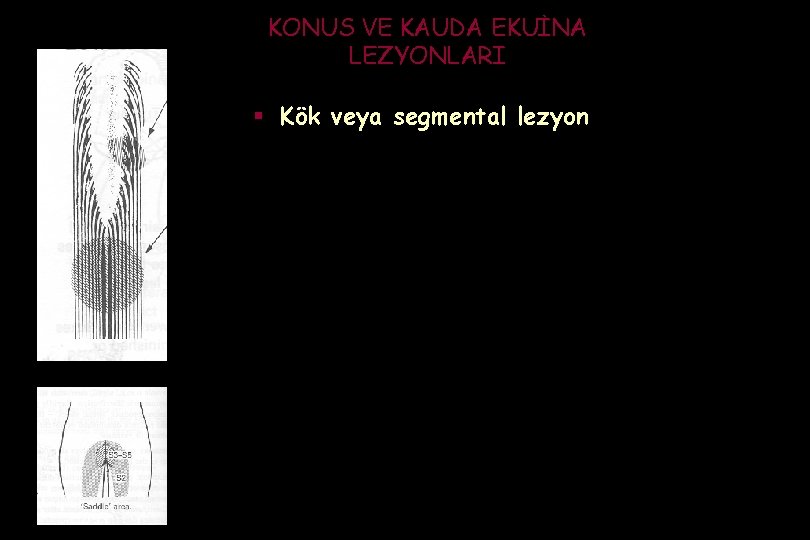 KONUS VE KAUDA EKUİNA LEZYONLARI § Kök veya segmental lezyon 