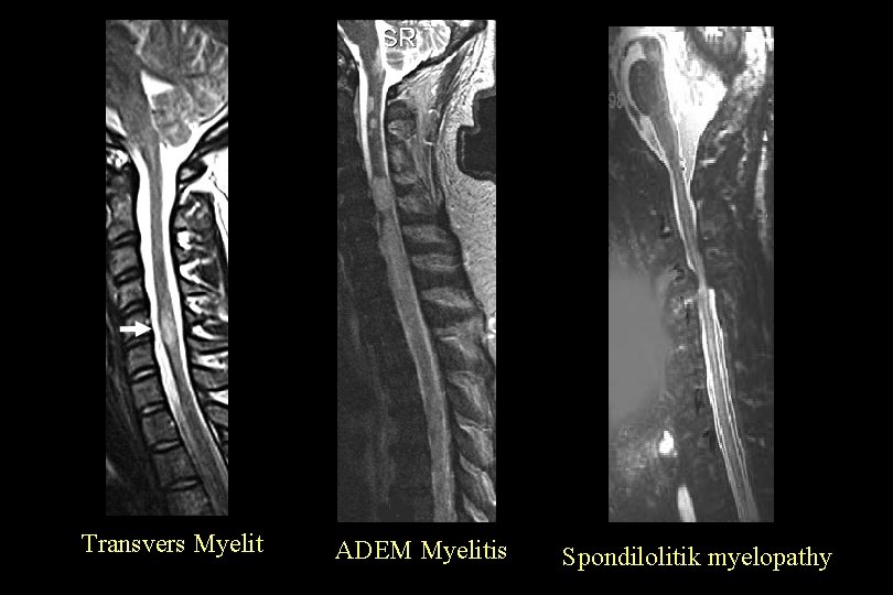 Transvers Myelit ADEM Myelitis Spondilolitik myelopathy 