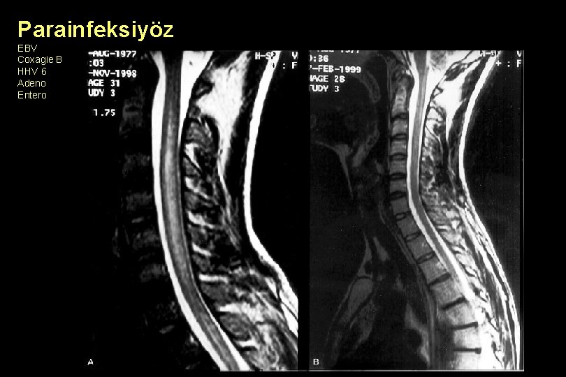 Parainfeksiyöz EBV Coxagie B HHV 6 Adeno Entero 