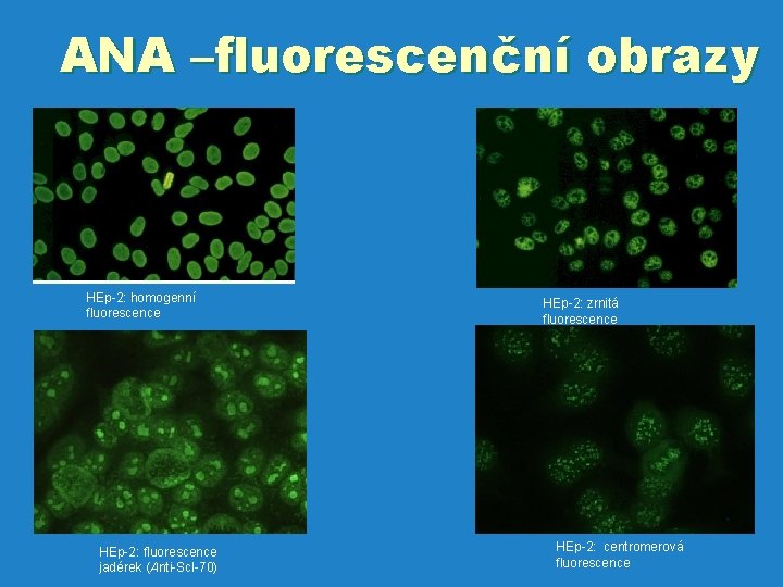 ANA –fluorescenční obrazy HEp-2: homogenní fluorescence HEp-2: fluorescence jadérek (Anti-Scl-70) HEp-2: zrnitá fluorescence HEp-2: