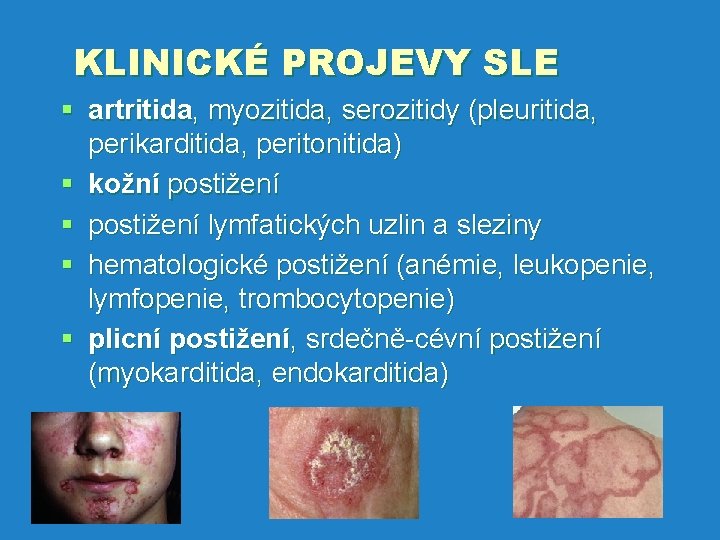 KLINICKÉ PROJEVY SLE § artritida, myozitida, serozitidy (pleuritida, perikarditida, peritonitida) § kožní postižení §