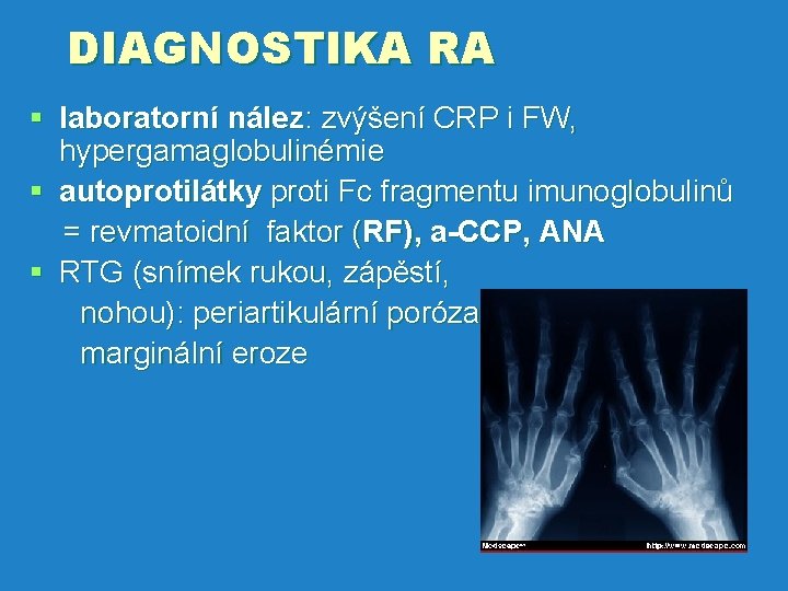 DIAGNOSTIKA RA § laboratorní nález: zvýšení CRP i FW, hypergamaglobulinémie § autoprotilátky proti Fc