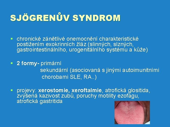 SJÖGRENŮV SYNDROM § chronické zánětlivé onemocnění charakteristické postižením exokrinních žláz (slinných, slzných, gastrointestinálního, urogenitálního