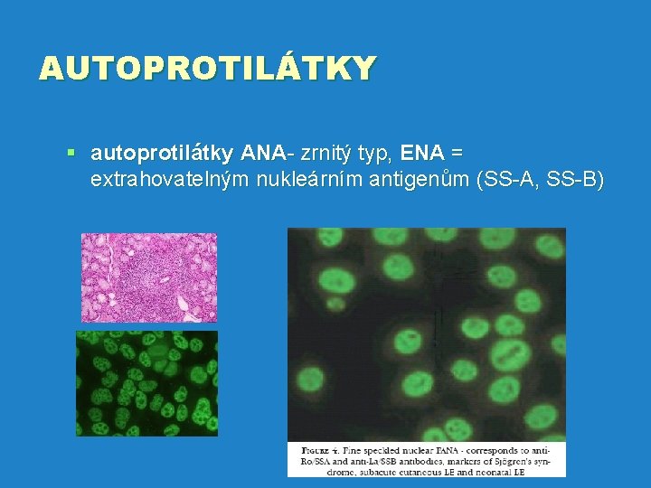 AUTOPROTILÁTKY § autoprotilátky ANA- zrnitý typ, ENA = extrahovatelným nukleárním antigenům (SS-A, SS-B) 