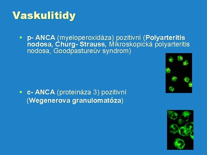 Vaskulitidy § p- ANCA (myeloperoxidáza) pozitivní (Polyarteritis nodosa, Churg- Strauss, Mikroskopická polyarteritis nodosa, Goodpastureův