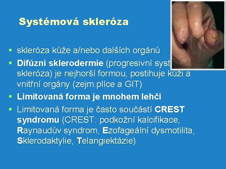 Systémová skleróza § skleróza kůže a/nebo dalších orgánů § Difúzní sklerodermie (progresivní systémová skleróza)