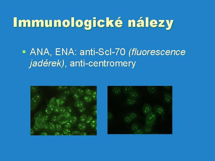 Immunologické nálezy § ANA, ENA: anti-Scl-70 (fluorescence jadérek), anti-centromery 