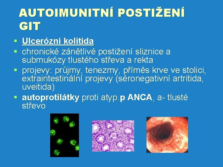 AUTOIMUNITNÍ POSTIŽENÍ GIT § Ulcerózní kolitida § chronické zánětlivé postižení sliznice a submukózy tlustého