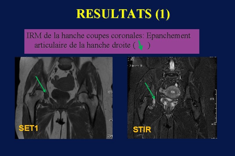RESULTATS (1) IRM de la hanche coupes coronales: Epanchement articulaire de la hanche droite