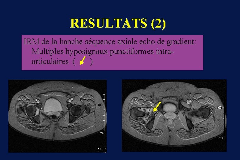 RESULTATS (2) IRM de la hanche séquence axiale echo de gradient: Multiples hyposignaux punctiformes