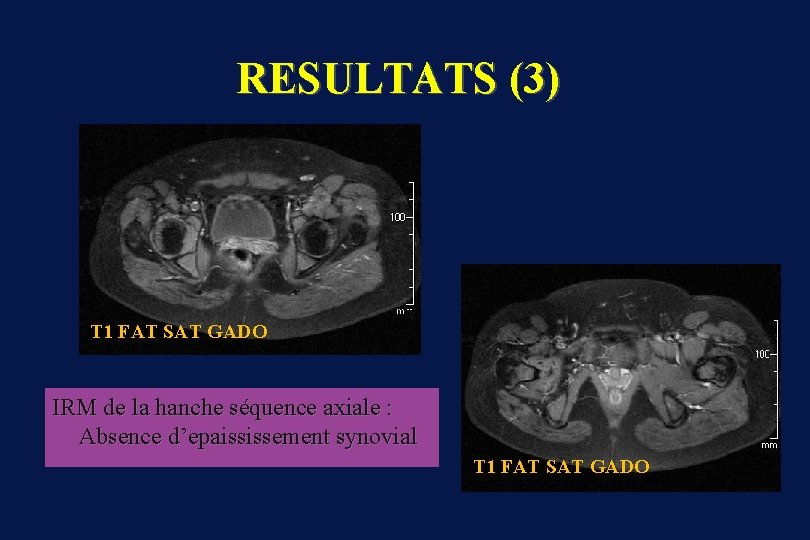 RESULTATS (3) T 1 FAT SAT GADO IRM de la hanche séquence axiale :
