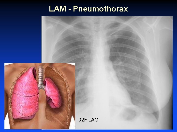 LAM - Pneumothorax 32 F LAM 