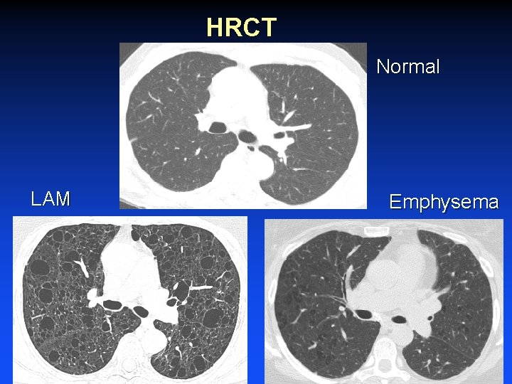 HRCT Normal LAM Emphysema 